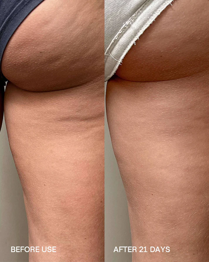 Biotyspa Body Sculpt Kit before and after body care routine results showing smoother looking skin after 21 days