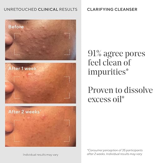 Before and after skin improvement results using MURAD Acne Control Clarifying Cleanser with text on clinical benefits.